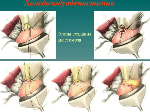 Холедоходуоденостомия Этапы создания анастомоза