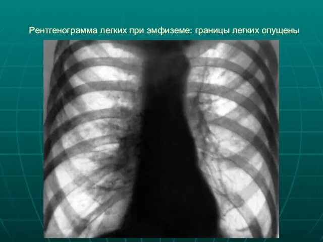 Рентгенограмма легких при эмфиземе: границы легких опущены
