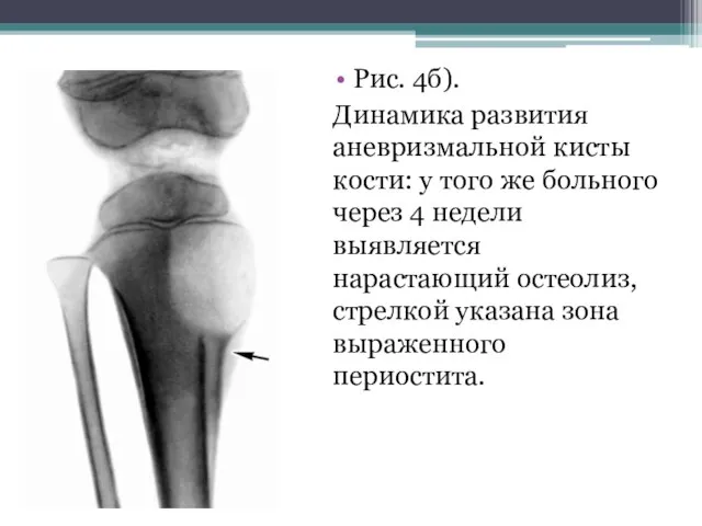 Рис. 4б). Динамика развития аневризмальной кисты кости: у того же больного