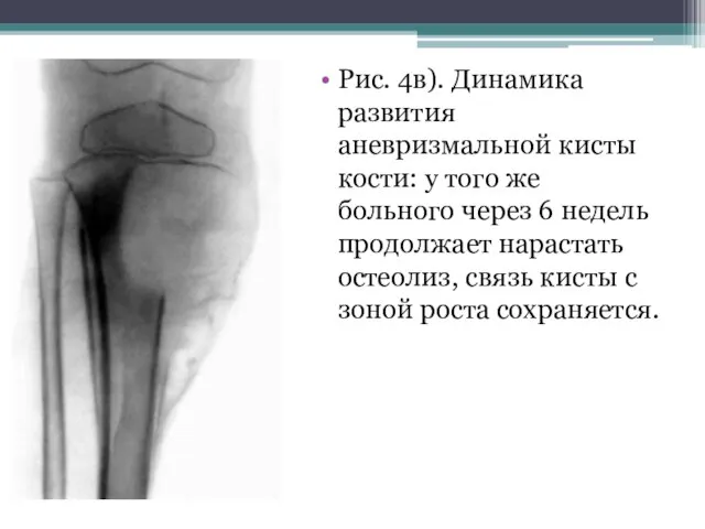 Рис. 4в). Динамика развития аневризмальной кисты кости: у того же больного