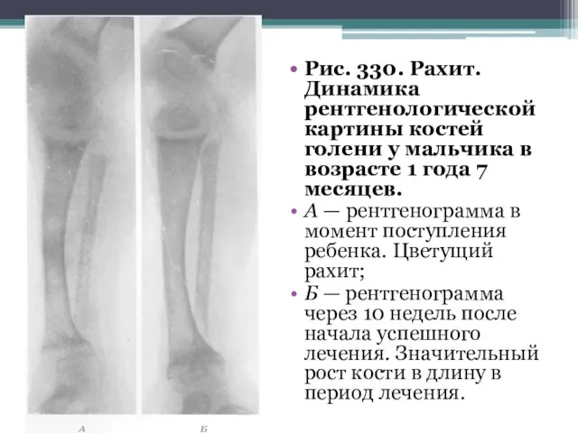 Рис. 330. Рахит. Динамика рентгенологической картины костей голени у мальчика в