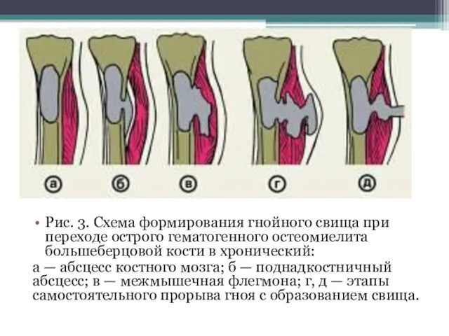 Рис. 3. Схема формирования гнойного свища при переходе острого гематогенного остеомиелита