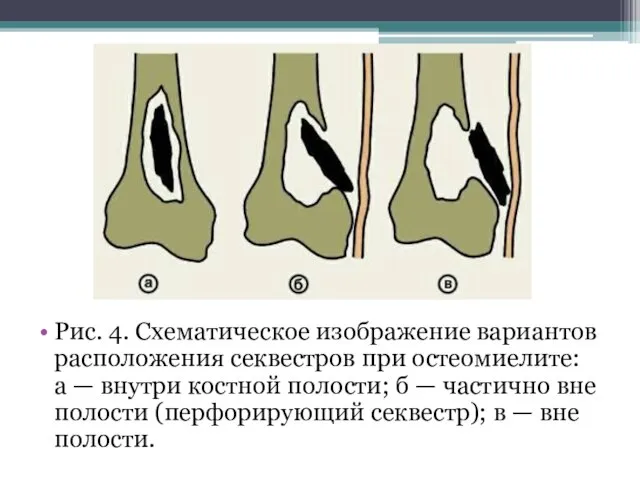 Рис. 4. Схематическое изображение вариантов расположения секвестров при остеомиелите: а —