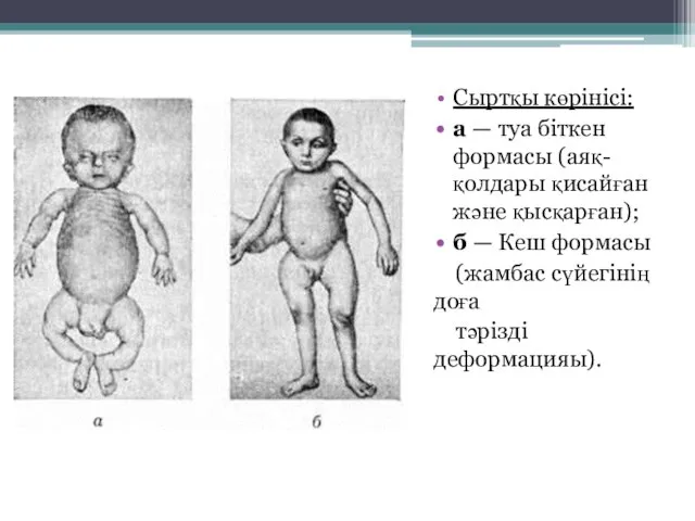 Сыртқы көрінісі: а — туа біткен формасы (аяқ-қолдары қисайған және қысқарған);