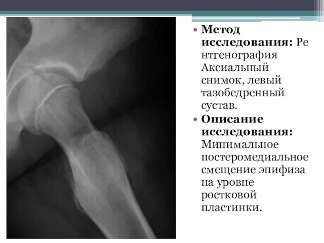 Метод исследования: Рентгенография Аксиальный снимок, левый тазобедренный сустав. Описание исследования: Минимальное