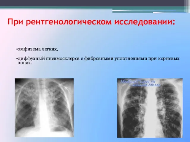 При рентгенологическом исследовании: эмфизема легких, диффузный пневмосклероз с фиброзными уплотнениями при корневых зонах.