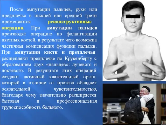 После ампутации пальцев, руки или предплечья в нижней или средней трети