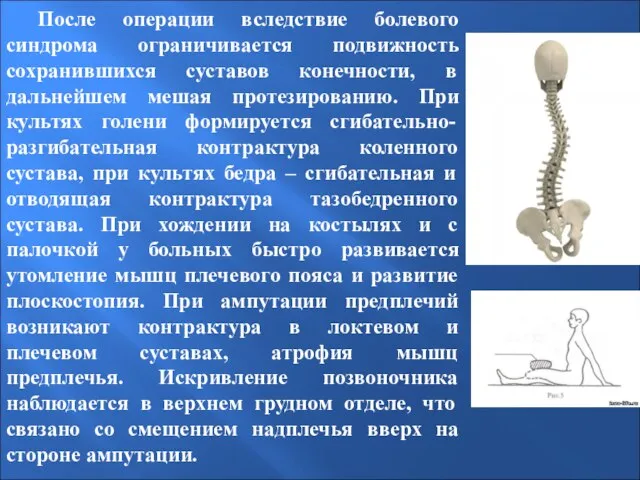 После операции вследствие болевого синдрома ограничивается подвижность сохранившихся суставов конечности, в