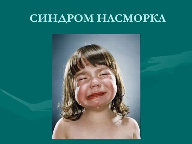 СИНДРОМ НАСМОРКА