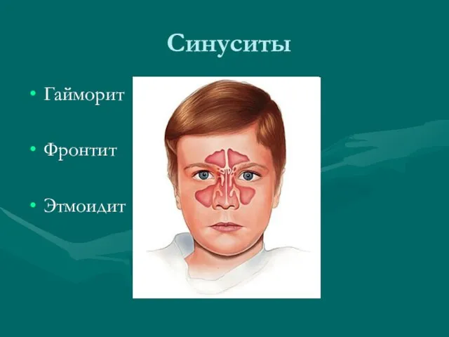 Синуситы Гайморит 3-4 года Фронтит 5-6 лет Этмоидит 7-8 лет