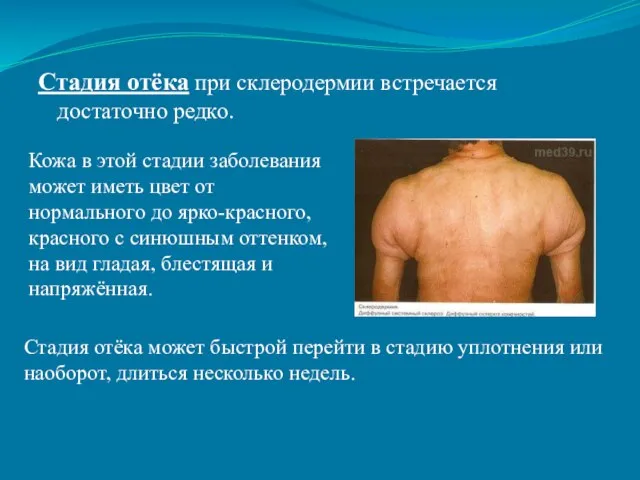 Стадия отёка при склеродермии встречается достаточно редко. Кожа в этой стадии