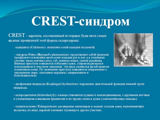 CREST-синдром - кальциноз (Calcinosis): скопление солей кальция под кожей; - синдром