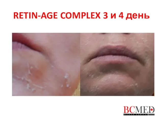 RETIN-AGE COMPLEX 3 и 4 день