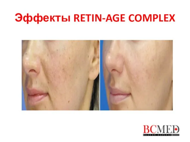 Эффекты RETIN-AGE COMPLEX