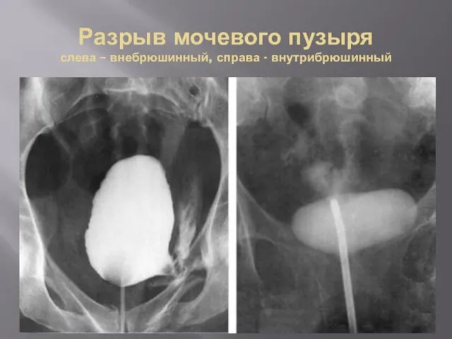 Разрыв мочевого пузыря слева – внебрюшинный, справа - внутрибрюшинный