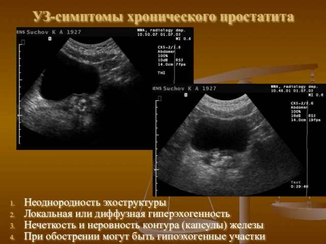 УЗ-симптомы хронического простатита Неоднородность эхоструктуры Локальная или диффузная гиперэхогенность Нечеткость и