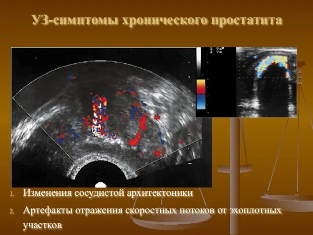 УЗ-симптомы хронического простатита Изменения сосудистой архитектоники Артефакты отражения скоростных потоков от эхоплотных участков