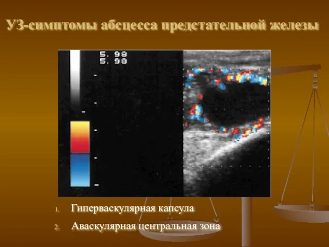 УЗ-симптомы абсцесса предстательной железы Гиперваскулярная капсула Аваскулярная центральная зона