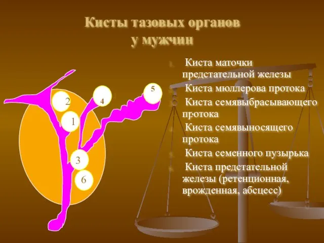 Кисты тазовых органов у мужчин Киста маточки предстательной железы Киста мюллерова