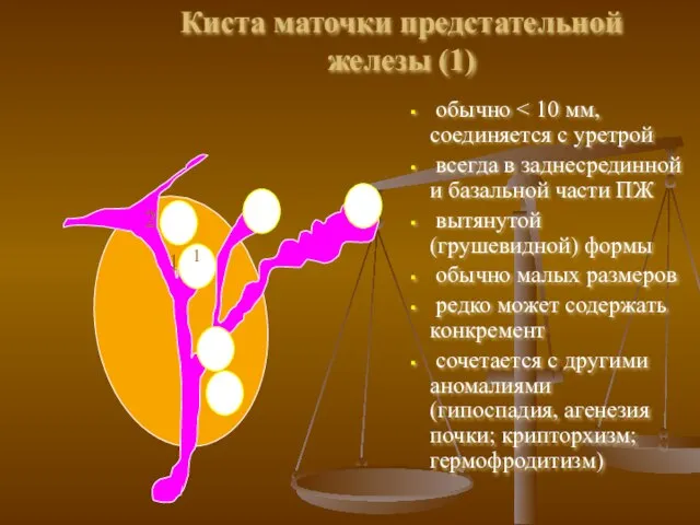 Киста маточки предстательной железы (1) обычно всегда в заднесрединной и базальной