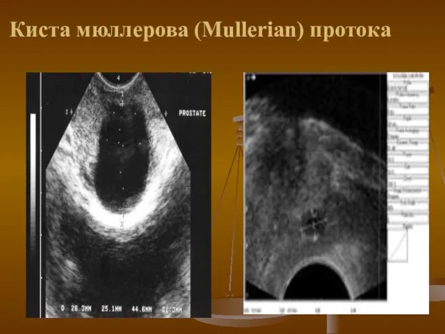 Киста мюллерова (Mullerian) протока