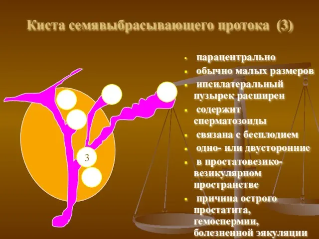 Киста семявыбрасывающего протока (3) парацентрально обычно малых размеров ипсилатеральный пузырек расширен