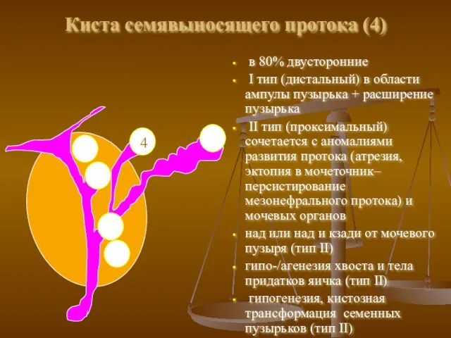 Киста семявыносящего протока (4) в 80% двусторонние I тип (дистальный) в