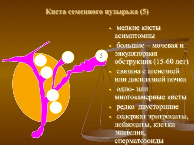 Киста семенного пузырька (5) мелкие кисты асимптомны большие – мочевая и