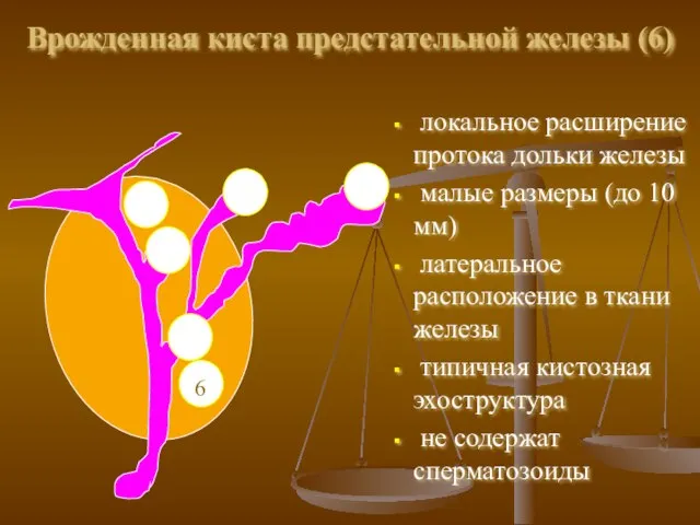 Врожденная киста предстательной железы (6) локальное расширение протока дольки железы малые