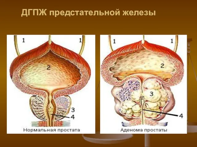 ДГПЖ предстательной железы