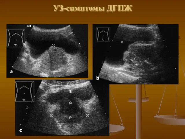 УЗ-симптомы ДГПЖ