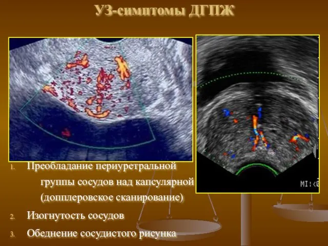 УЗ-симптомы ДГПЖ Преобладание периуретральной группы сосудов над капсулярной (допплеровское сканирование) Изогнутость сосудов Обеднение сосудистого рисунка