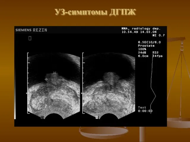 УЗ-симптомы ДГПЖ