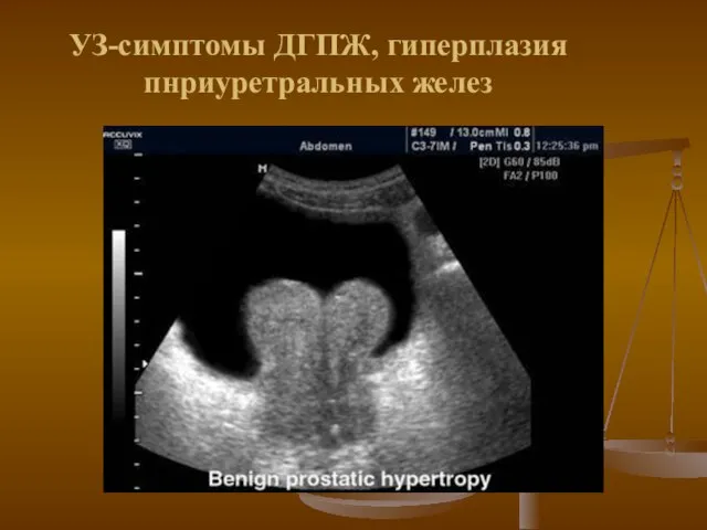 УЗ-симптомы ДГПЖ, гиперплазия пнриуретральных желез