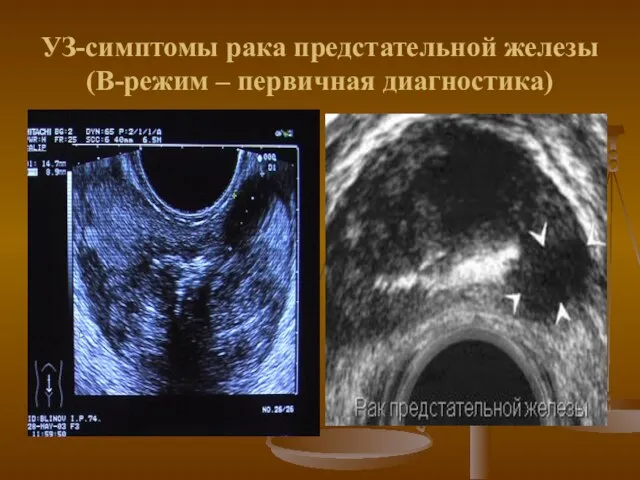 УЗ-симптомы рака предстательной железы (В-режим – первичная диагностика)