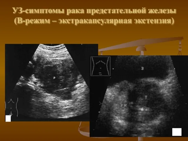 УЗ-симптомы рака предстательной железы (В-режим – экстракапсулярная экстензия)