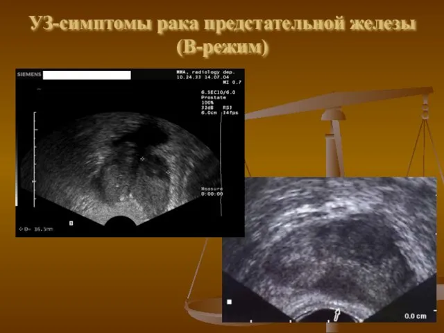 УЗ-симптомы рака предстательной железы (В-режим)