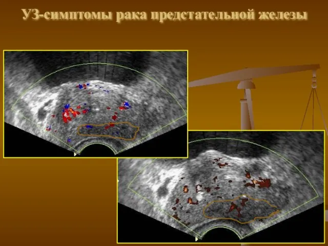 УЗ-симптомы рака предстательной железы