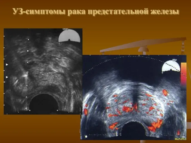 УЗ-симптомы рака предстательной железы