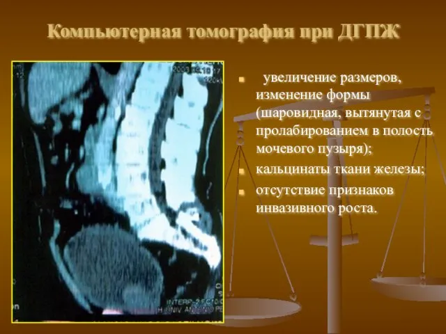 Компьютерная томография при ДГПЖ увеличение размеров, изменение формы (шаровидная, вытянутая с