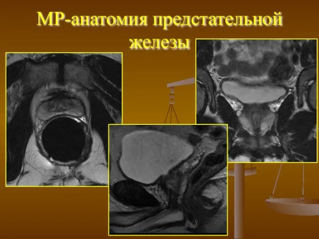 МР-анатомия предстательной железы