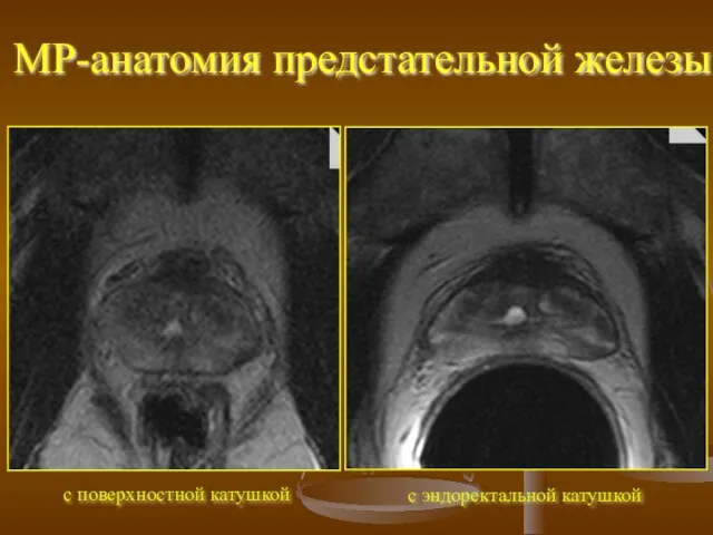 с поверхностной катушкой МР-анатомия предстательной железы с эндоректальной катушкой