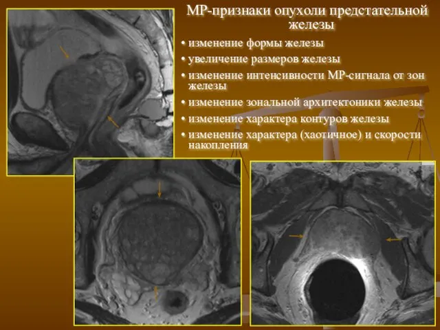 МР-признаки опухоли предстательной железы изменение формы железы увеличение размеров железы изменение