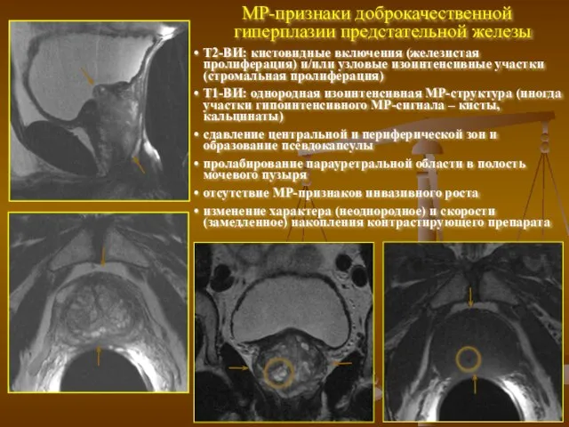 МР-признаки доброкачественной гиперплазии предстательной железы Т2-ВИ: кистовидные включения (железистая пролиферация) и/или