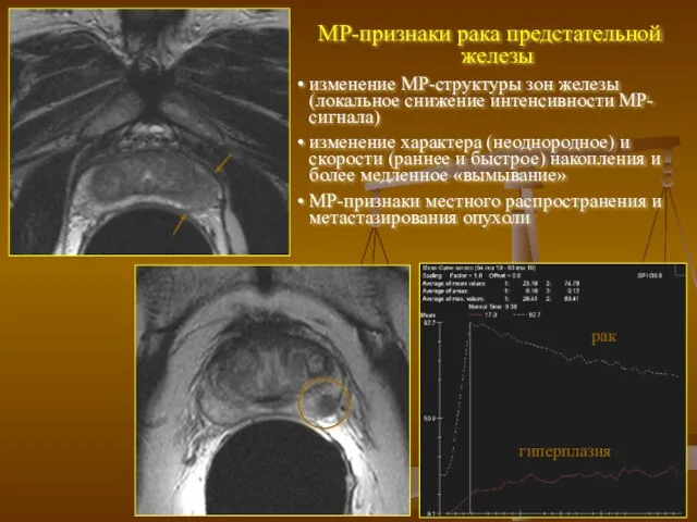 МР-признаки рака предстательной железы изменение МР-структуры зон железы (локальное снижение интенсивности