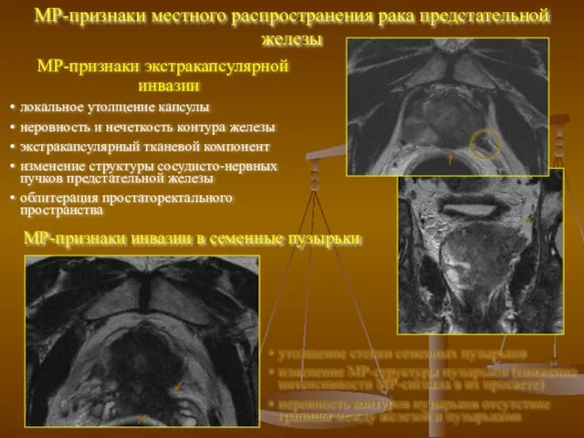 МР-признаки экстракапсулярной инвазии локальное утолщение капсулы неровность и нечеткость контура железы