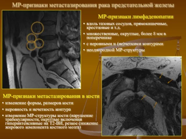 МР-признаки метастазирования рака предстательной железы МР-признаки лимфаденопатии вдоль тазовых сосудов, прямокишечные,