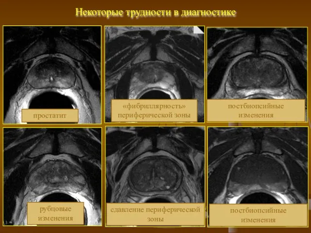 Некоторые трудности в диагностике простатит рубцовые изменения «фибриллярность» периферической зоны сдавление