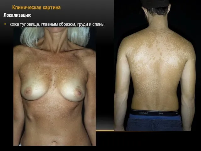 Клиническая картина Локализация: кожа туловища, главным образом, груди и спины;