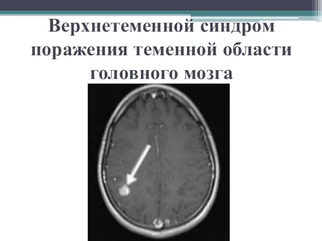 Верхнетеменной синдром поражения теменной области головного мозга